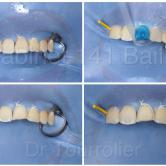 Facettes dentaires spécialiste