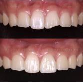 Spécialiste Facettes dentaires à Marseille -Cabinet 141 Baille