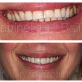 Facettes dentaires specialiste Marseille