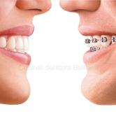 Invisalign Marseille