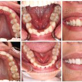 Orthodontie par gouttières invisalign® Marseille